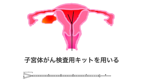 子宮内膜スクラッチ