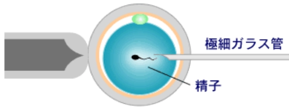 顕微授精（ICSI）
