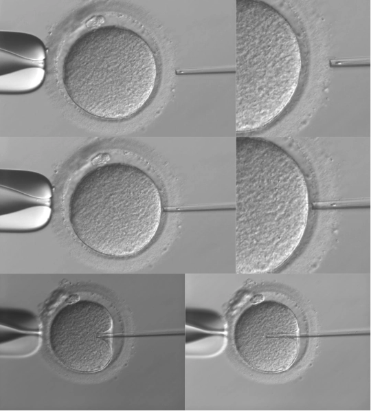 当院で行っている方法：PIEZOを用いた顕微授精