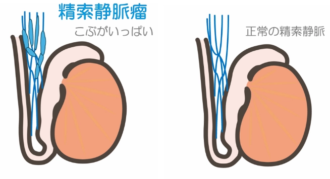 精索静脈瘤
