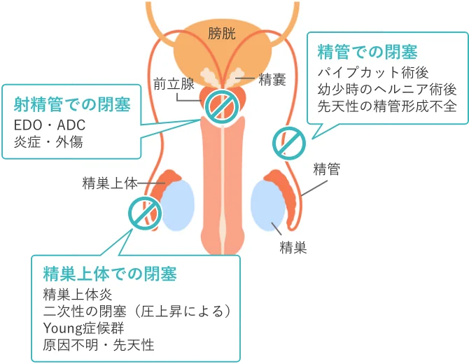 閉塞性無精子症