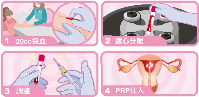 PRP療法の流れ