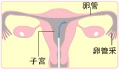 カテーテルを腟から子宮へ挿入し卵管に近づけるイラスト
