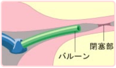 カテーテルのバルーンを膨らませて卵管内へ進めるイラスト