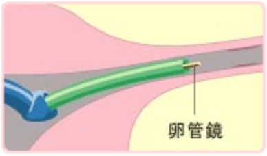 卵管鏡を使って卵管内を観察するイラスト
